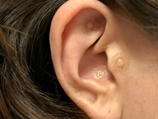 耳つぼ療法